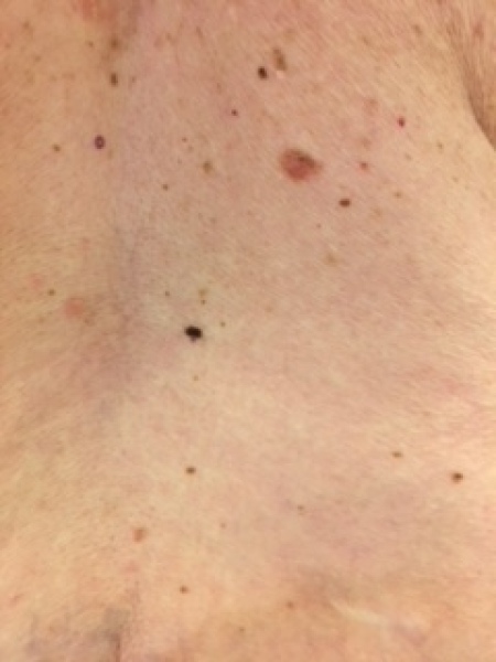 Abnormal mole or something more serious? 