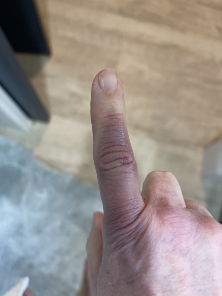 Achenbach syndrome - help, please!