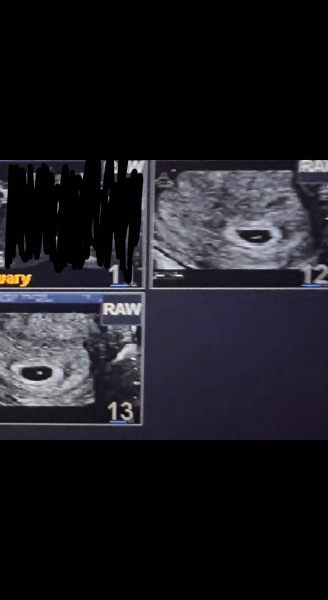 Worried after 5 week scan - sac but no yolk