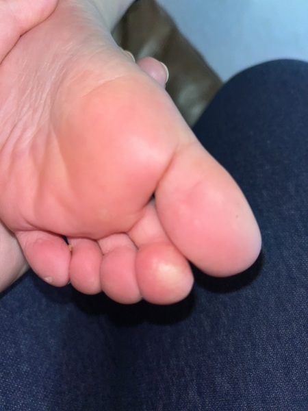 What is this on my child's toe (photos)
