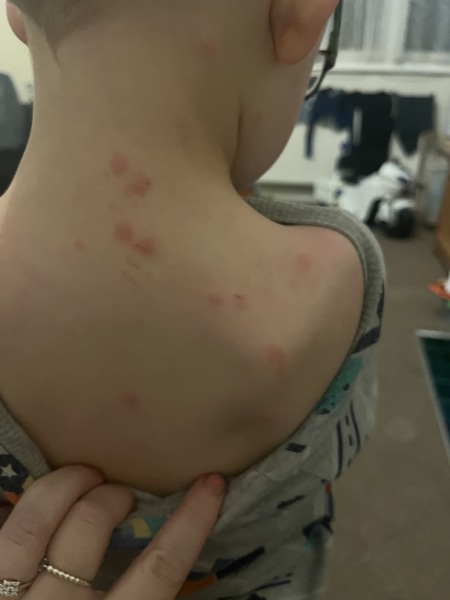 ? chicken pox ?