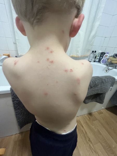 CP of bed bugs or another bite!?  