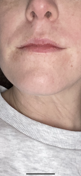 White coated lips and burning - causing anxiety 