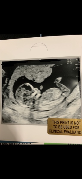 Sex guess from 13 week scan!