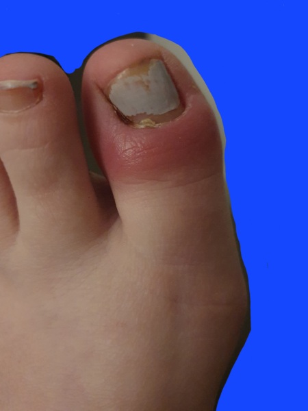 Don't know what to do about my toe