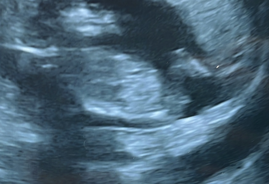 Nub theory guesses please! 13w5 scan