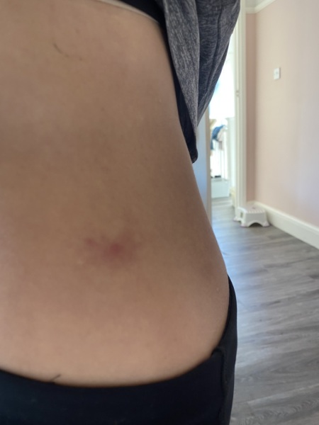 Worrying that this is a tick bite?