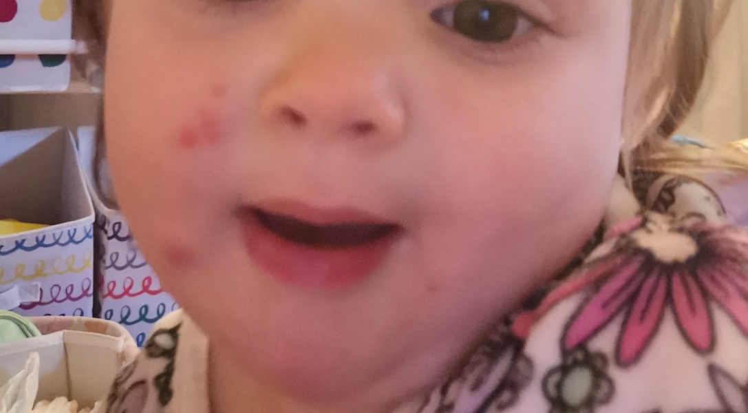Spots on DDs face