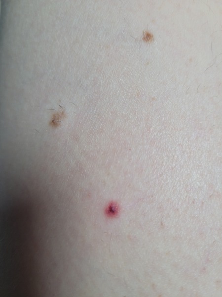Worrying mole