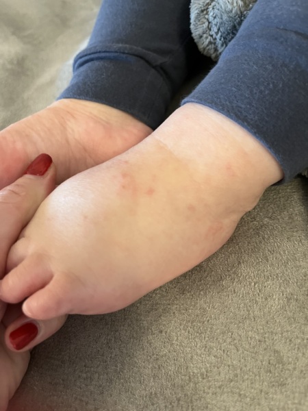 Hand, foot & mouth? Nursery?