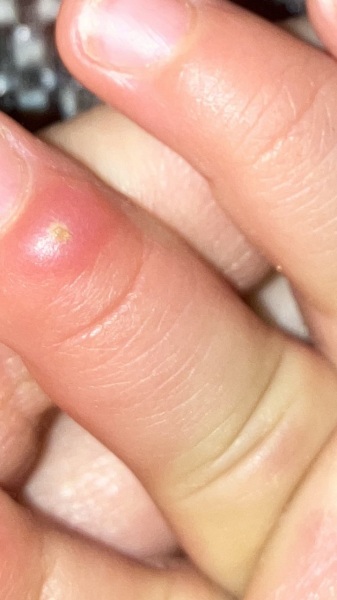 Any idea what this is on baby finger