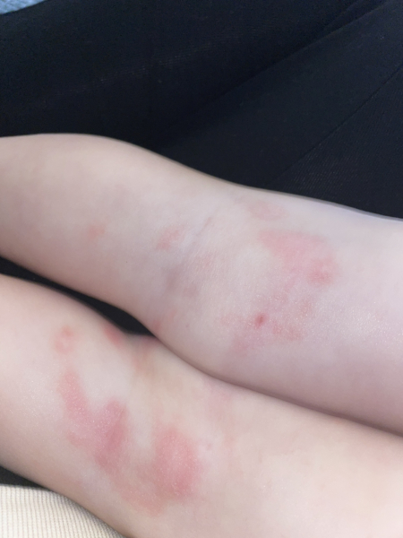 Is this really ringworm?