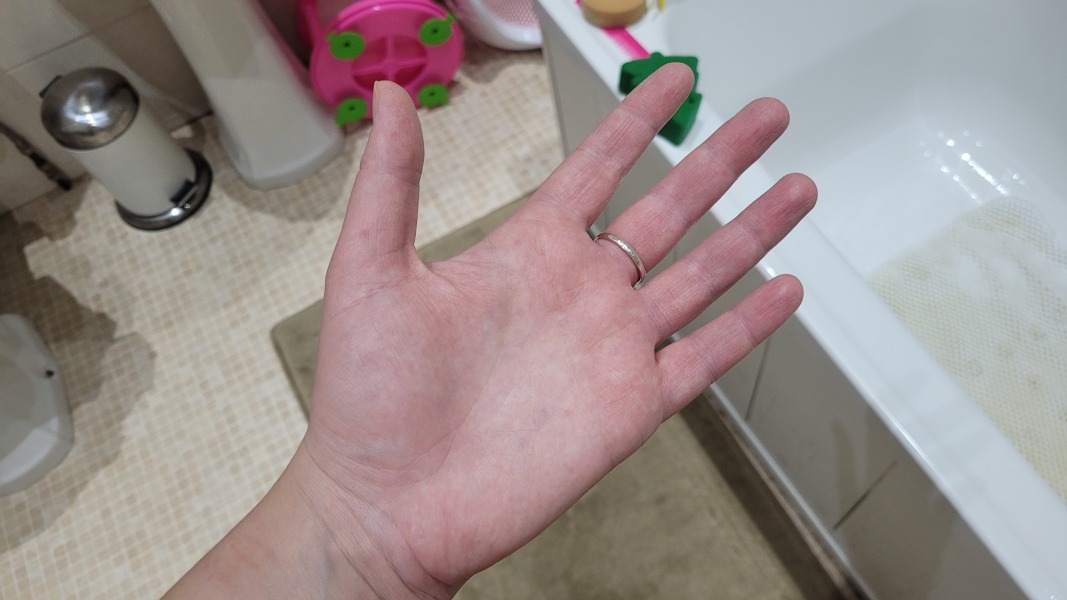 Early hand foot and mouth?