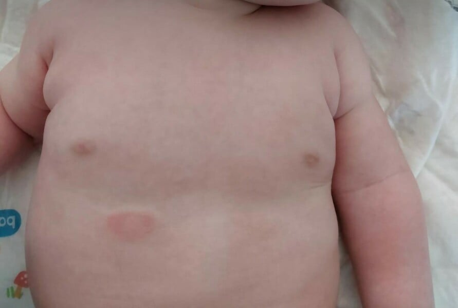 Ringworm? Stethoscope at the doctor's practice responsible?