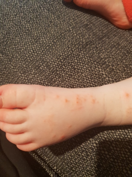 Chickenpox 