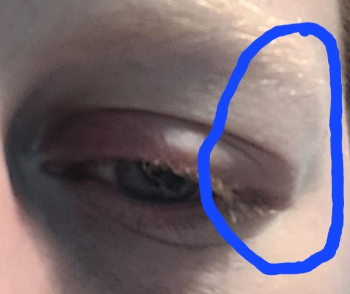 WTH wrong with my eye?