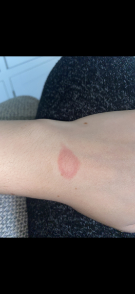 Lyme disease or nothing to worry about?