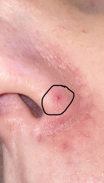 Red mark on nose - broken vein?