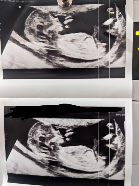 Nub theory 14 weeks?!