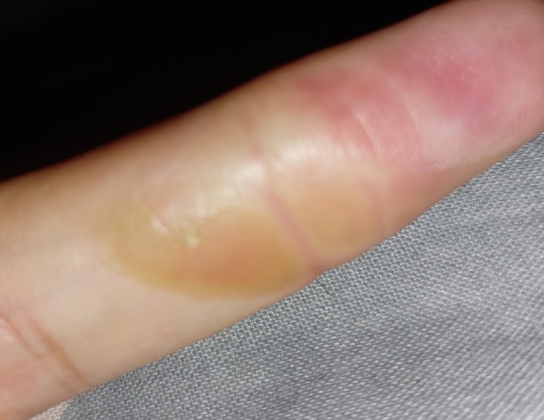 How to soften a burn (photo attached)