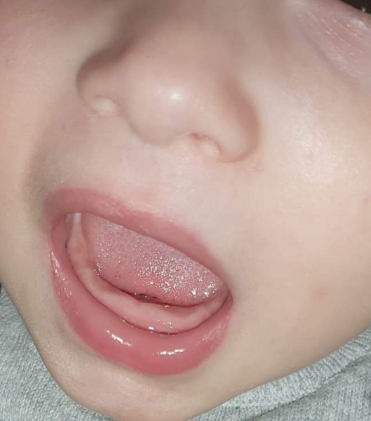 Teething 