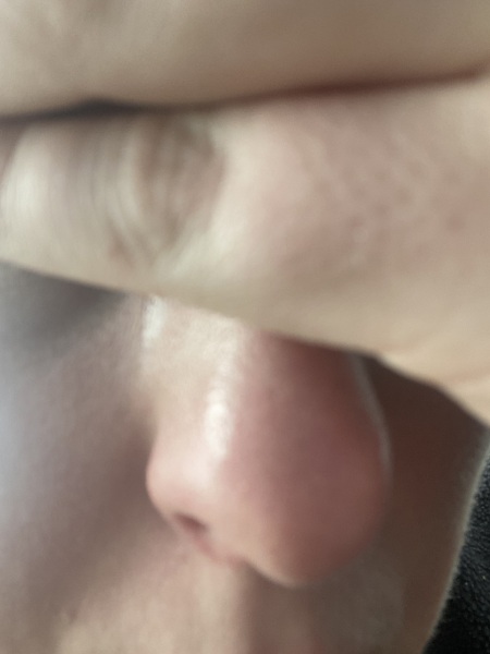 Subaceous filament or black head?