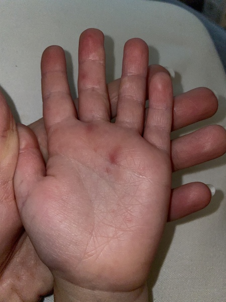 Hand, foot and mouth? 