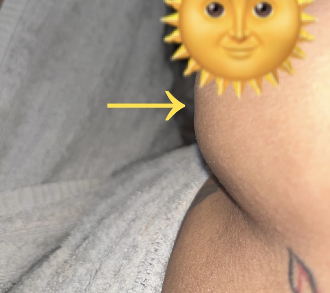 Breast cancer - dimple