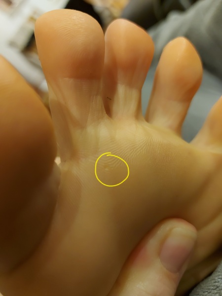 If I bazooka, but it's not a verucca...