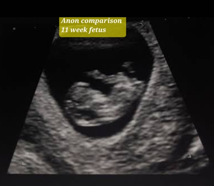 Due May 2023 - thread two