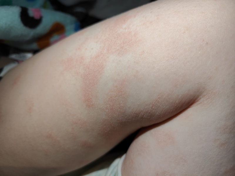 Leg rash on three year old girl