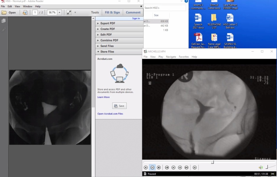 Recurrent miscarriage - HSG