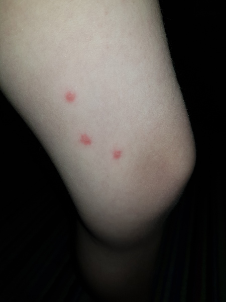 To ask what's biting me? 