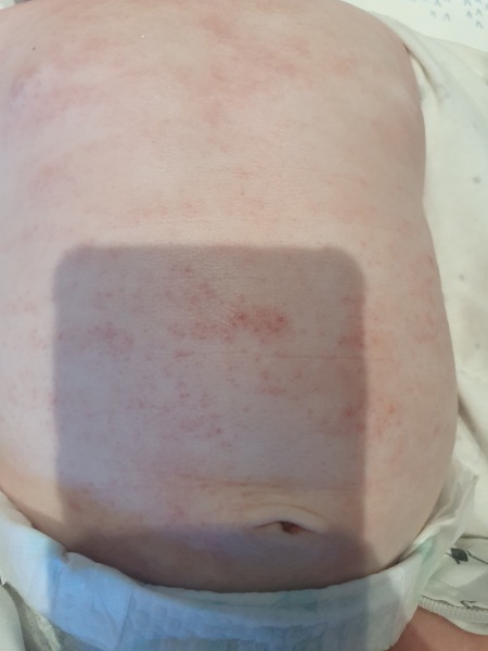 Baby's eczema