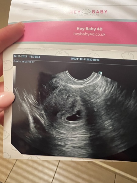 Am I miscarrying? 