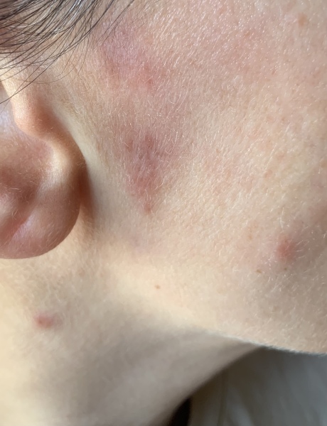 Rash on face after bug bite. What could it be?