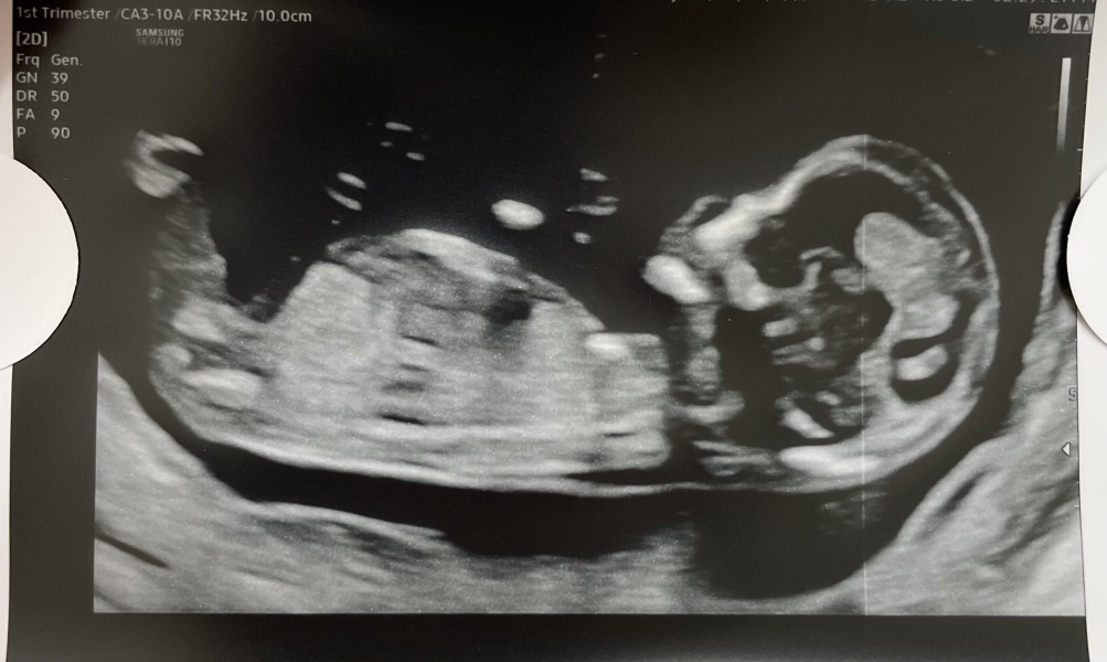 Very early pregnancy and so much anxiety after miscarriage