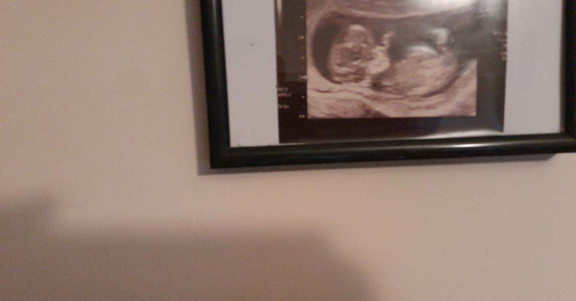 13 week ultrasound