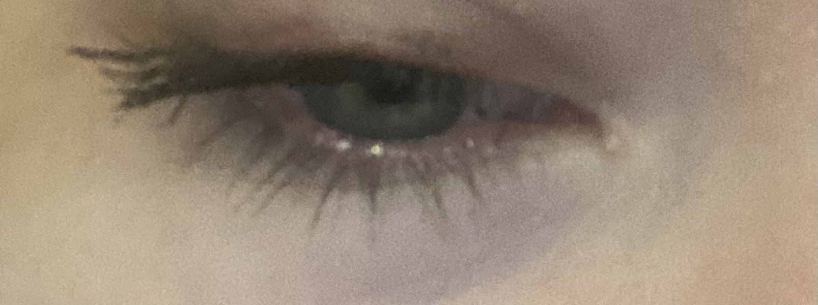 What is this bump on the corner of my eye?