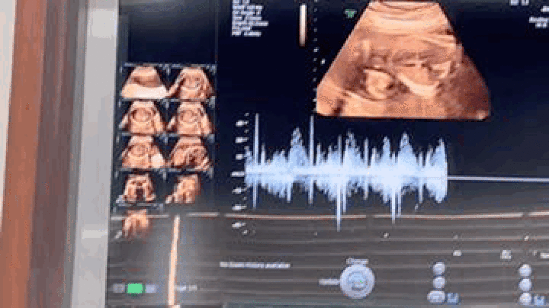 Recorded Video While Anomaly Scan