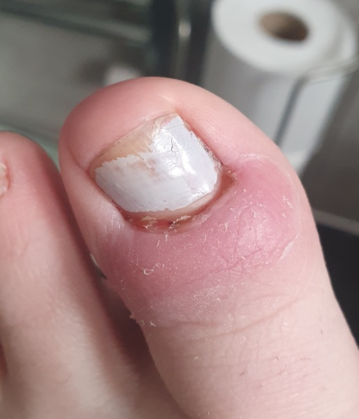 Infected toe?