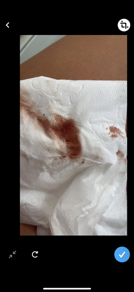 WARNING PIC&TMI implantation bleeding?