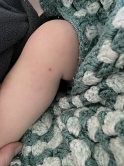 Baby rash