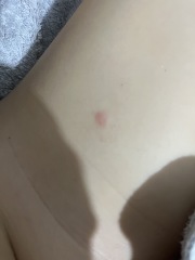 CP of bed bugs or another bite!?  