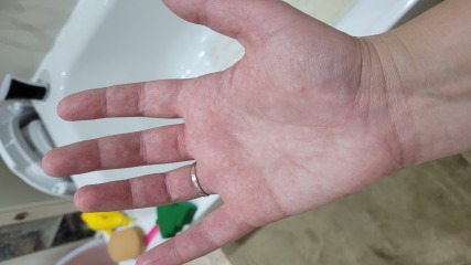 Early hand foot and mouth?