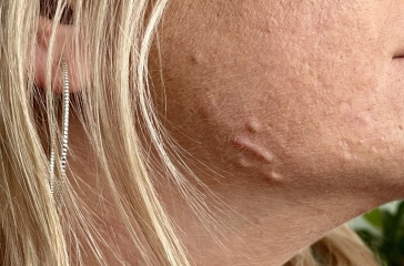 Pics of my scarred face ! Spots