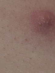 Spot on ds (23 yr) back - photo