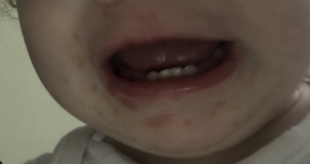Hand food and mouth or chicken pox - second opinion?