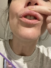 White coated lips and burning - causing anxiety 