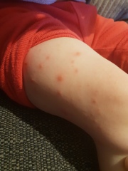 Chickenpox 